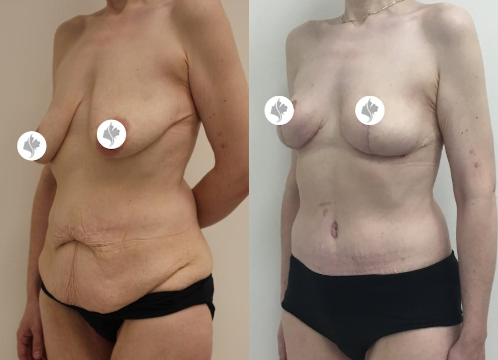 This is one of our beautiful post-bariatric body contouring patient #19