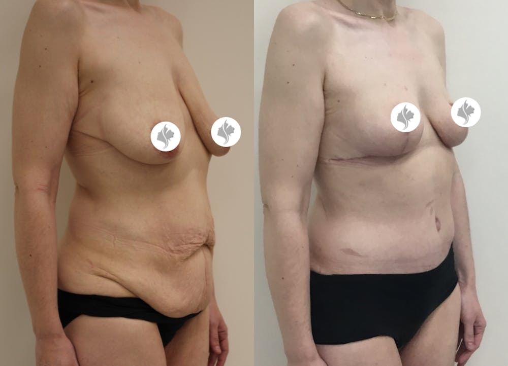 This is one of our beautiful post-bariatric body contouring patient #19