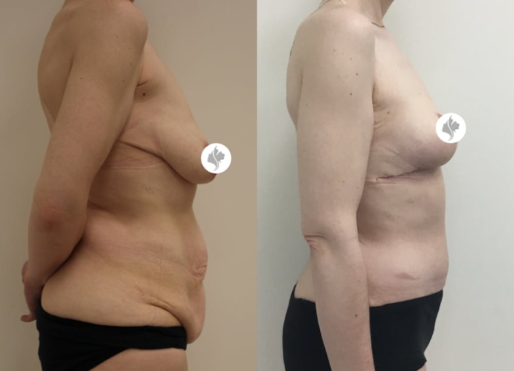 This is one of our beautiful tummy tuck patient #43