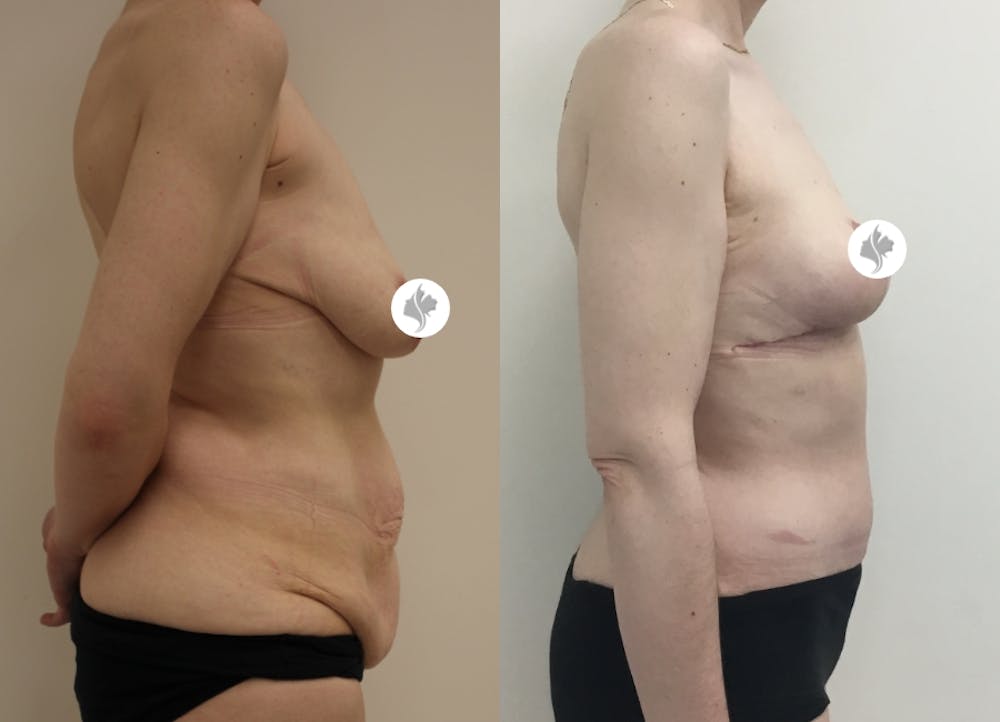 This is one of our beautiful post-bariatric body contouring patient #19
