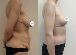 This is one of our beautiful post-bariatric body contouring patient 19