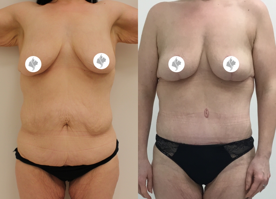 This is one of our beautiful post-bariatric body contouring patient 21