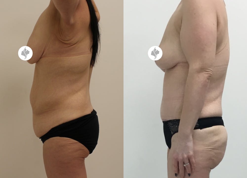 This is one of our beautiful post-bariatric body contouring patient #21