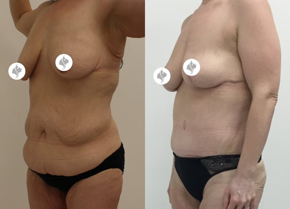 This is one of our beautiful post-bariatric body contouring patient #21