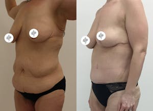 This is one of our beautiful tummy tuck patient 40