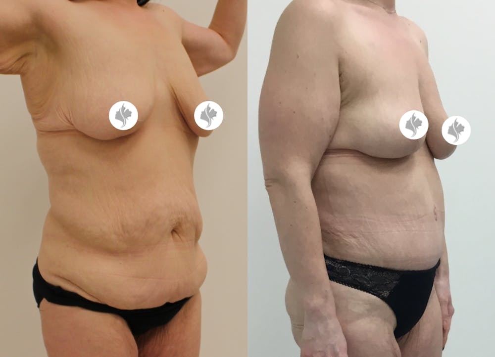 This is one of our beautiful post-bariatric body contouring patient #21