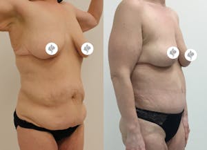 This is one of our beautiful tummy tuck patient 40