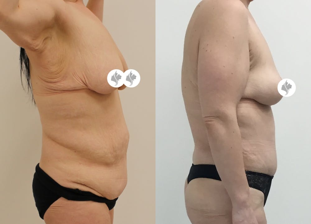 This is one of our beautiful post-bariatric body contouring patient #21