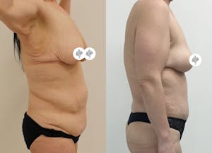 This is one of our beautiful post-bariatric body contouring patient 21