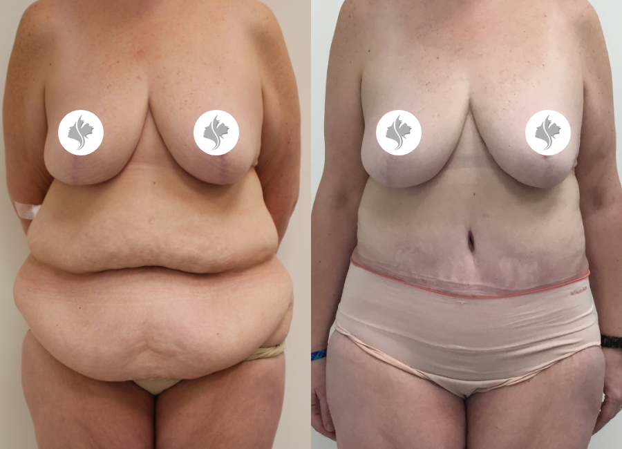 This is one of our beautiful post-bariatric body contouring patient 22