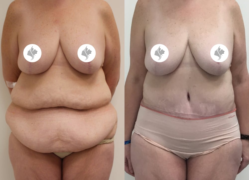 This is one of our beautiful tummy tuck patient #45