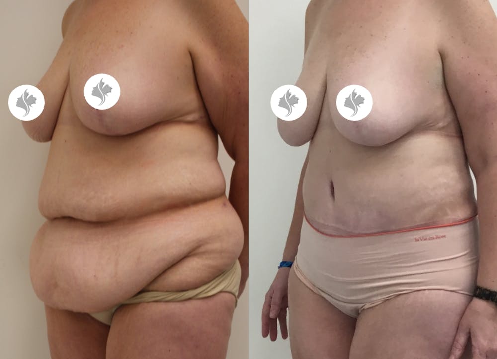 This is one of our beautiful post-bariatric body contouring patient #22