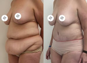 This is one of our beautiful post-bariatric body contouring patient 22