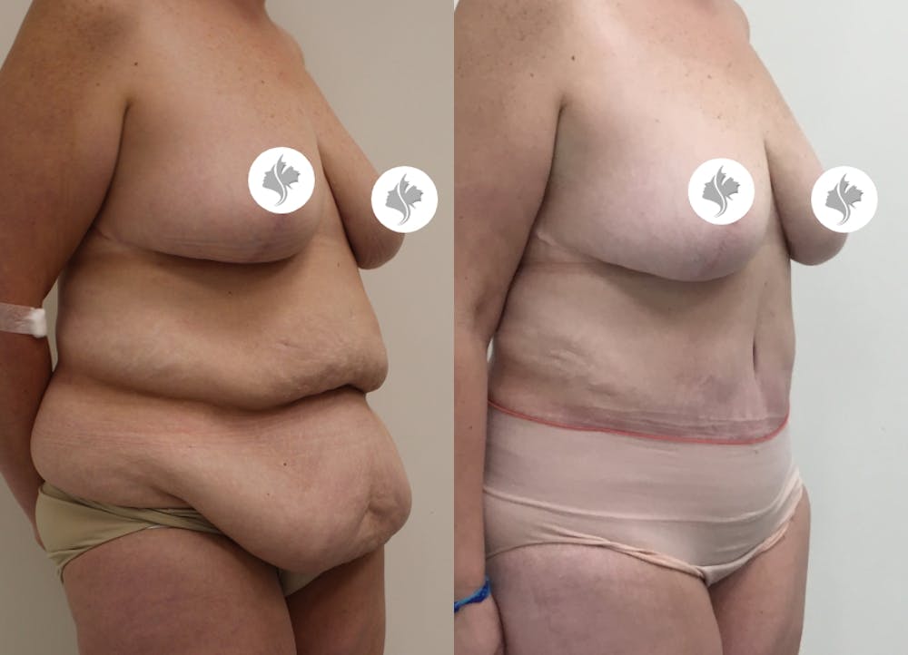 This is one of our beautiful tummy tuck patient #45