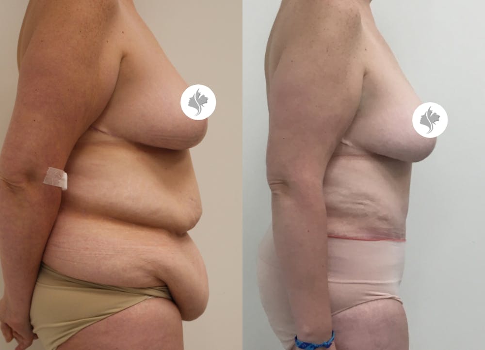 This is one of our beautiful post-bariatric body contouring patient #22
