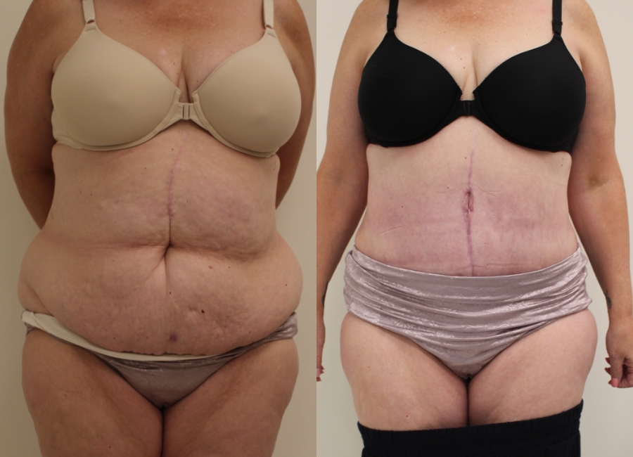 This is one of our beautiful post-bariatric body contouring patient 23