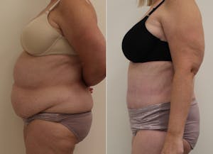 This is one of our beautiful post-bariatric body contouring patient 23