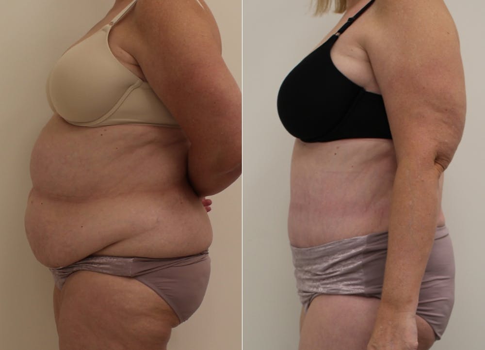 This is one of our beautiful post-bariatric body contouring patient #23