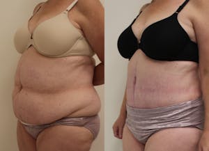 This is one of our beautiful tummy tuck patient 42