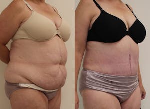 This is one of our beautiful post-bariatric body contouring patient 23