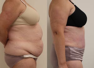 This is one of our beautiful post-bariatric body contouring patient 23