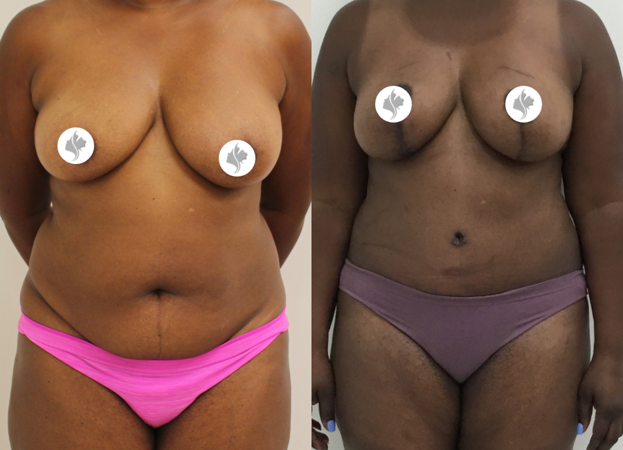 This is one of our beautiful tummy tuck patient 47