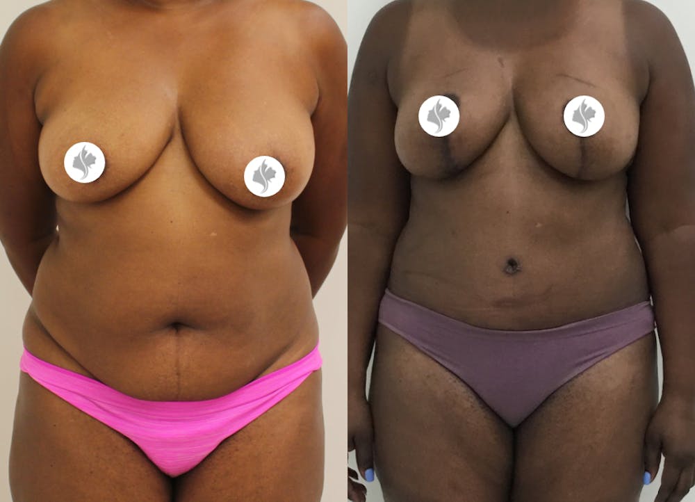 This is one of our beautiful tummy tuck patient #43