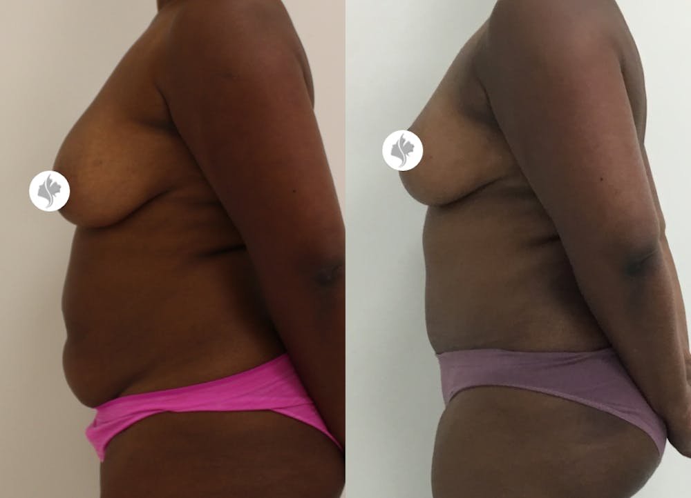 This is one of our beautiful tummy tuck patient #43