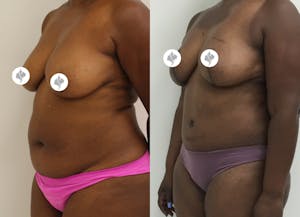 This is one of our beautiful tummy tuck patient 43