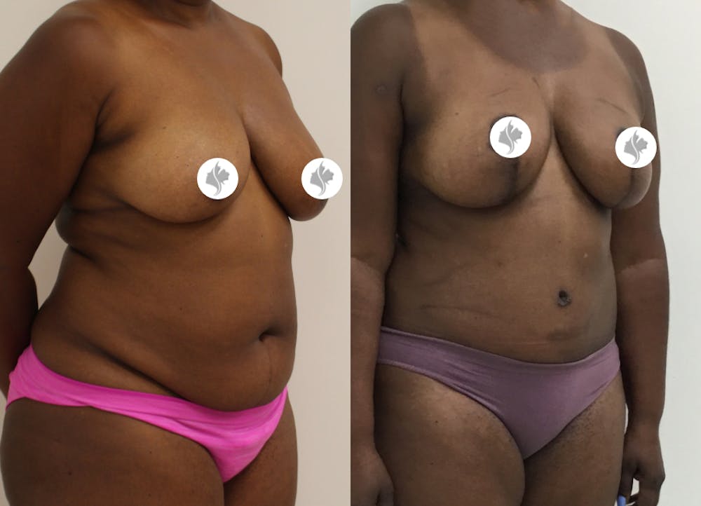 This is one of our beautiful tummy tuck patient #43