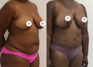 This is one of our beautiful tummy tuck patient 43