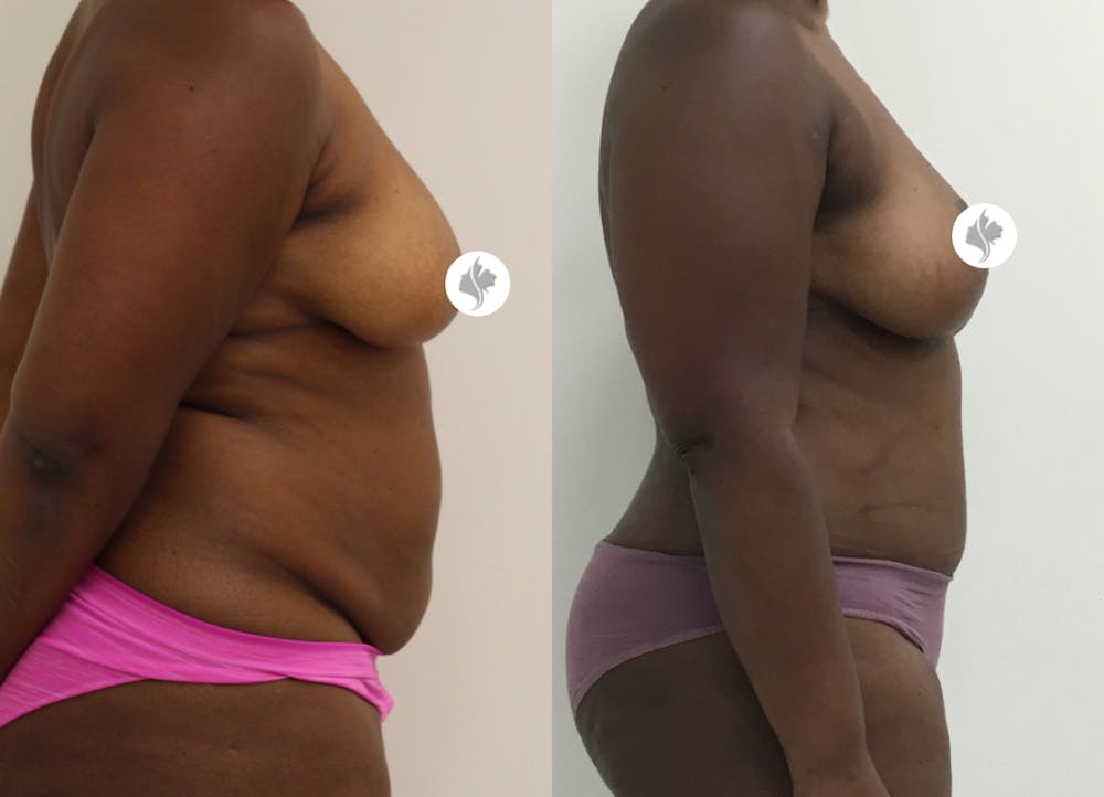 This is one of our beautiful tummy tuck patient #47