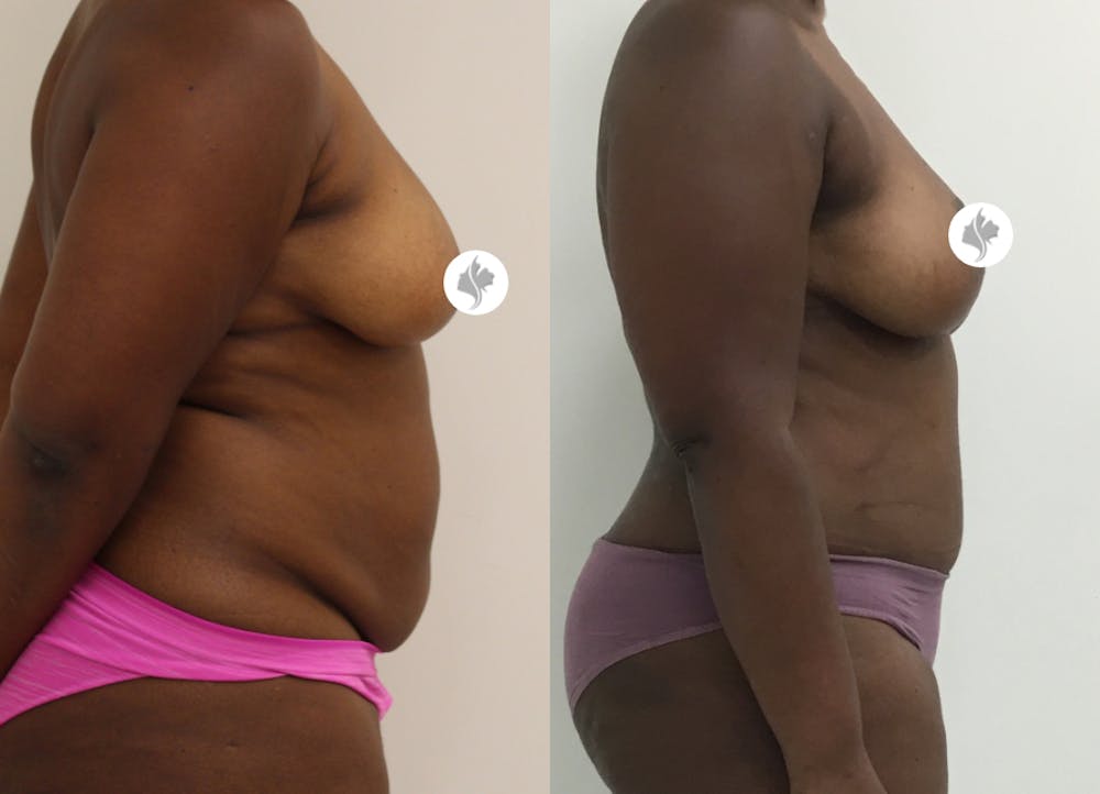 This is one of our beautiful tummy tuck patient #43