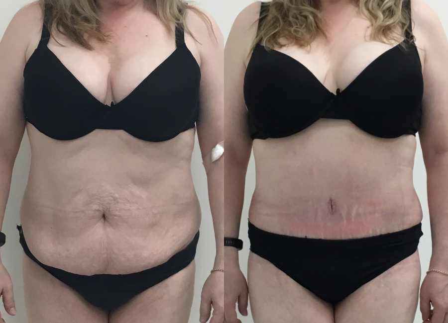 This is one of our beautiful tummy tuck patient 48