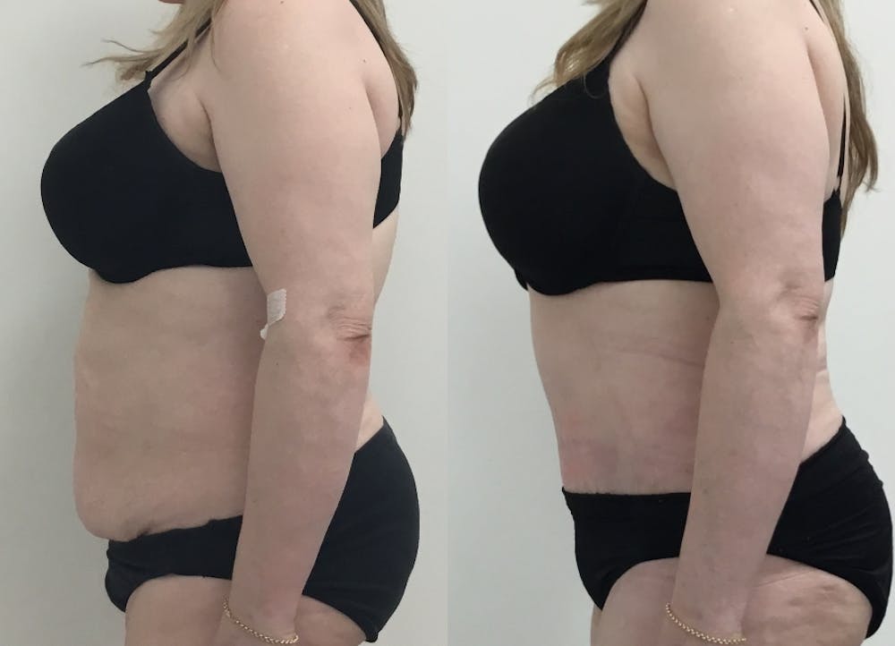 This is one of our beautiful post-bariatric body contouring patient #24