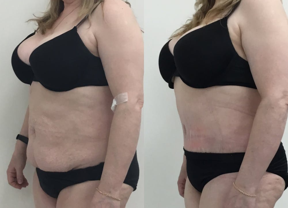 This is one of our beautiful post-bariatric body contouring patient #24