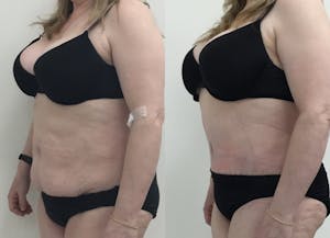This is one of our beautiful tummy tuck patient 44
