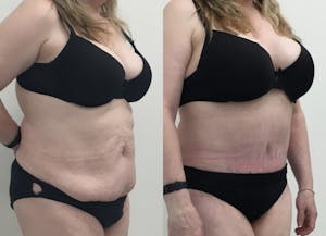 This is one of our beautiful post-bariatric body contouring patient 24