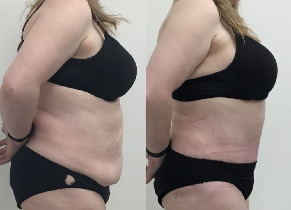 This is one of our beautiful post-bariatric body contouring patient #24