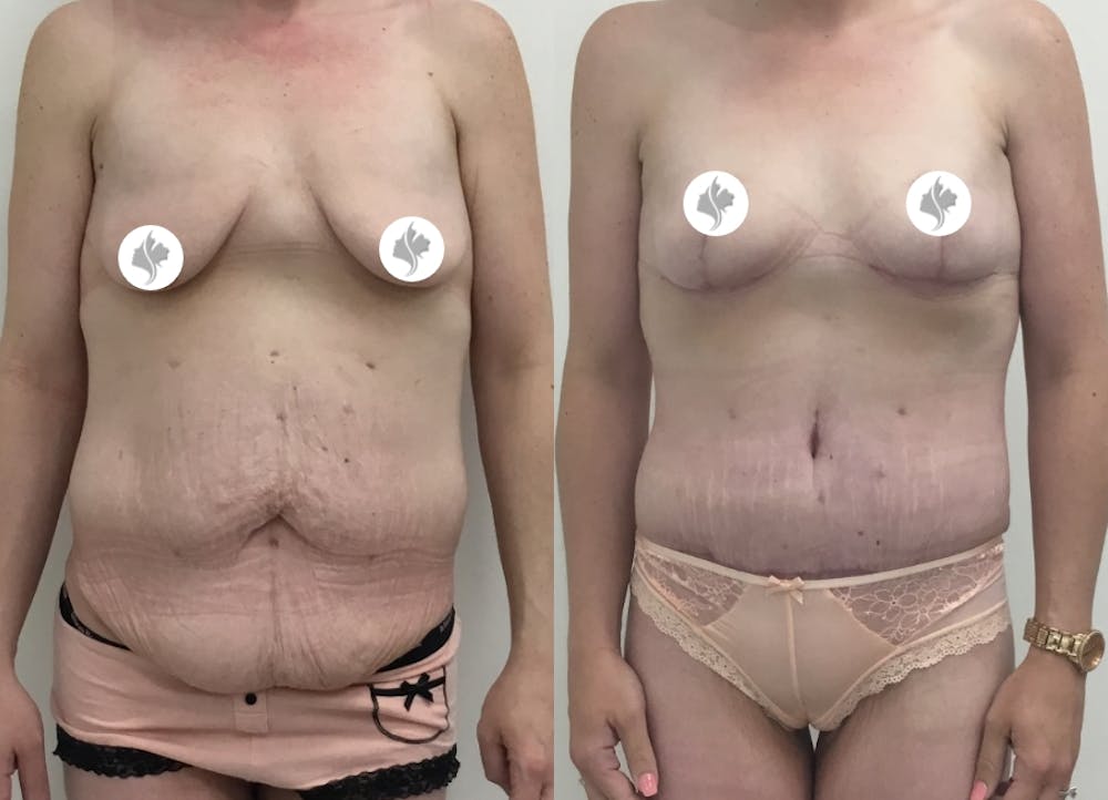 This is one of our beautiful tummy tuck patient #45