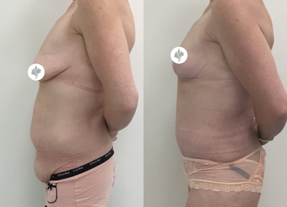 This is one of our beautiful tummy tuck patient #45