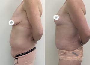 This is one of our beautiful tummy tuck patient 45