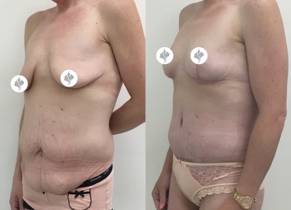 This is one of our beautiful tummy tuck patient #45