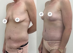 This is one of our beautiful tummy tuck patient 45