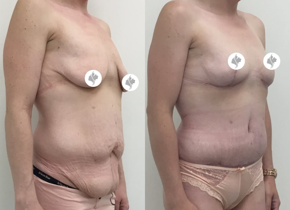 This is one of our beautiful tummy tuck patient #45