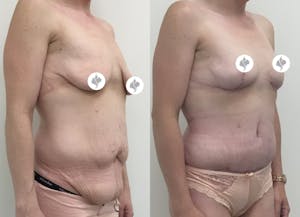 This is one of our beautiful tummy tuck patient 45