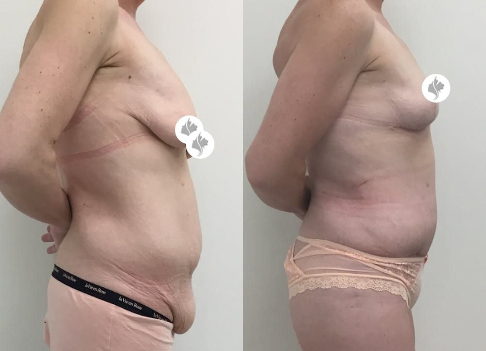 This is one of our beautiful tummy tuck patient #45