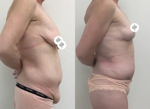 This is one of our beautiful tummy tuck patient 45