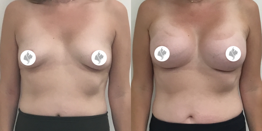 This is one of our beautiful breast augmentation patient 19