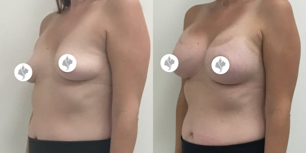 This is one of our beautiful breast augmentation patient #19